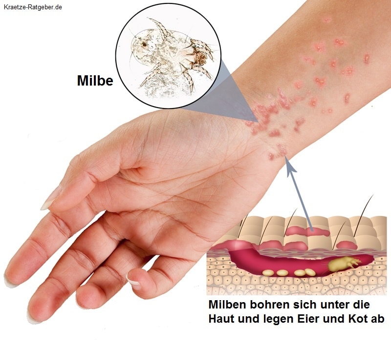Scabies on arm - Stock Image M260/0378 - Science Photo Library
